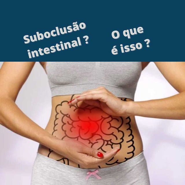 Suboclusão intestinal – Sérgio Teixeira