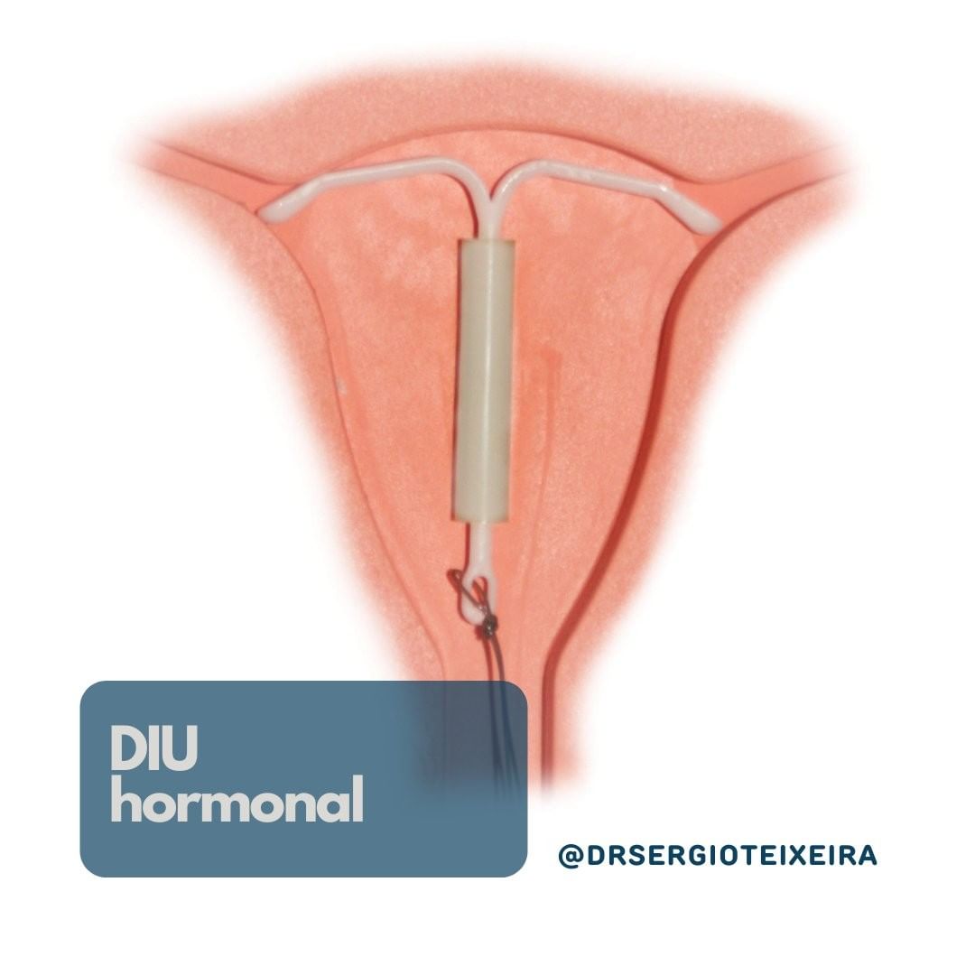 Como funciona o DIU hormonal – Sérgio Teixeira
